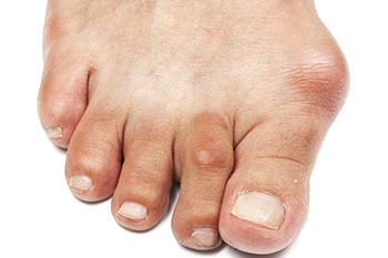 Bunions treatment in the Ventura County, CA: Camarillo (Oxnard, Thousand Oaks, Ventura, Santa Paula), Los Angeles County: Los Angeles (Santa Clarita, Glendale, Pasadena, Burbank, Santa Monica) areas