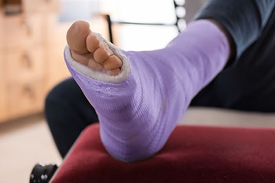 Broken Foot and Ankle Treatment in Ventura County, CA: Camarillo (Oxnard, Thousand Oaks, Ventura, Santa Paula), Los Angeles County: Los Angeles (Santa Clarita, Glendale, Pasadena, Burbank, Santa Monica) areas