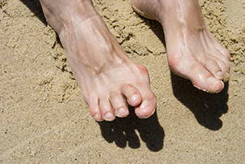 Hammertoe & Mallet Toe Treatment in the Ventura County, CA: Camarillo (Oxnard, Thousand Oaks, Ventura, Santa Paula), Los Angeles County: Los Angeles (Santa Clarita, Glendale, Pasadena, Burbank, Santa Monica) areas