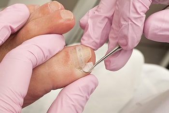 Ingrown Toenails Diagnosis & Treatment in the Ventura County, CA: Camarillo (Oxnard, Thousand Oaks, Ventura, Santa Paula), Los Angeles County: Los Angeles (Santa Clarita, Glendale, Pasadena, Burbank, Santa Monica) areas