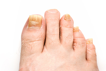 Toenail Fungus Diagnosis & Treatment in the Ventura County, CA: Camarillo (Oxnard, Thousand Oaks, Ventura, Santa Paula), Los Angeles County: Los Angeles (Santa Clarita, Glendale, Pasadena, Burbank, Santa Monica) areas