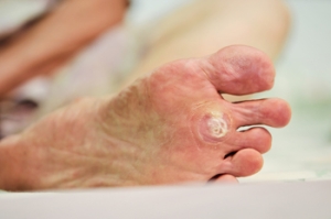 Types and Symptoms of Plantar Warts