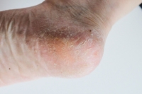 Cracked Heels and Who Is Most at Risk